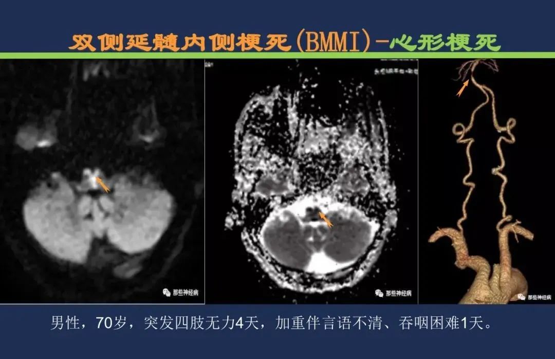 影像PPT - 从梗死部位推测责任血管:脑血管解剖-195 影像PPT - 从梗死部位推测责任血管:脑血管解剖-195