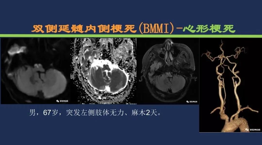 影像PPT - 从梗死部位推测责任血管:脑血管解剖-196 影像PPT - 从梗死部位推测责任血管:脑血管解剖-196