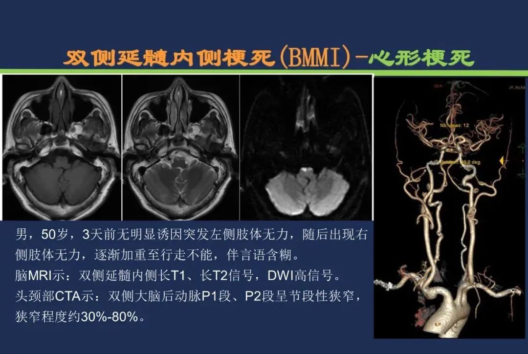 影像PPT - 从梗死部位推测责任血管:脑血管解剖-197 影像PPT - 从梗死部位推测责任血管:脑血管解剖-197