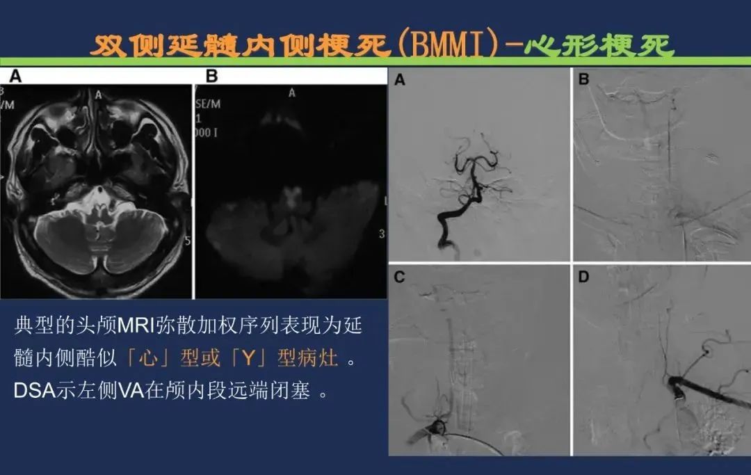 影像PPT - 从梗死部位推测责任血管:脑血管解剖-198 影像PPT - 从梗死部位推测责任血管:脑血管解剖-198