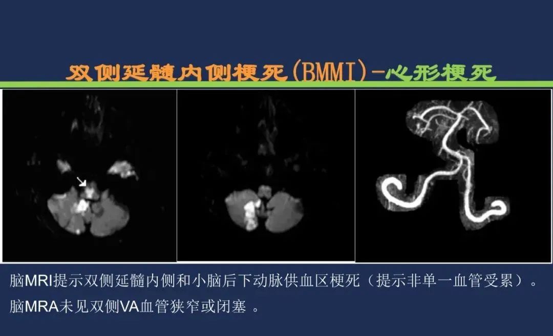 影像PPT - 从梗死部位推测责任血管:脑血管解剖-199 影像PPT - 从梗死部位推测责任血管:脑血管解剖-199