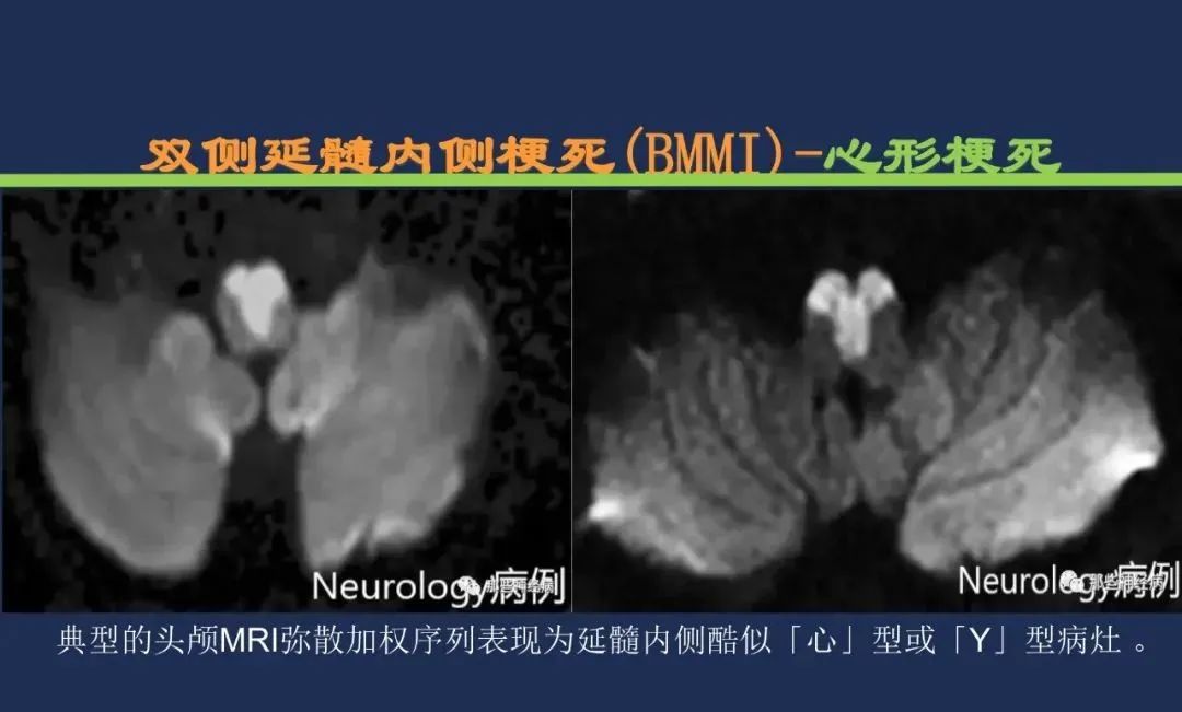 影像PPT - 从梗死部位推测责任血管:脑血管解剖-200 影像PPT - 从梗死部位推测责任血管:脑血管解剖-200