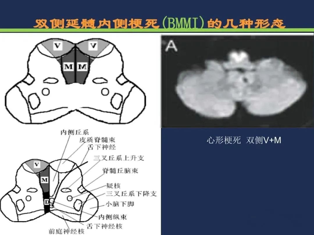 影像PPT - 从梗死部位推测责任血管:脑血管解剖-201 影像PPT - 从梗死部位推测责任血管:脑血管解剖-201