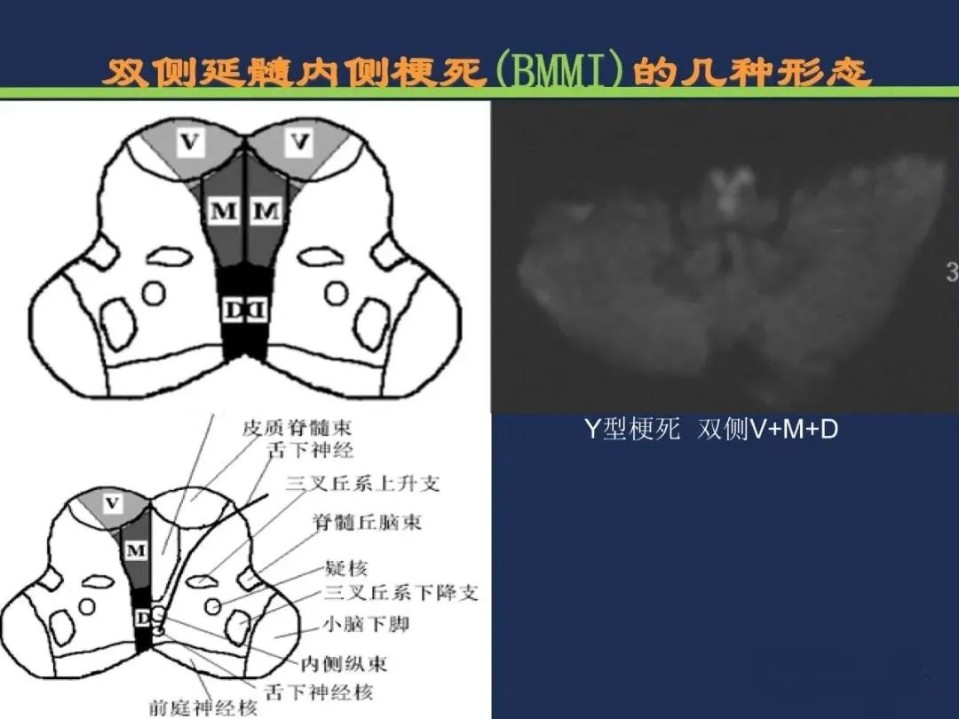 影像PPT - 从梗死部位推测责任血管:脑血管解剖-202 影像PPT - 从梗死部位推测责任血管:脑血管解剖-202