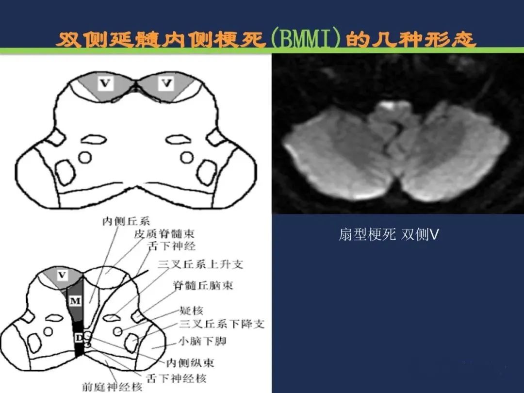 影像PPT - 从梗死部位推测责任血管:脑血管解剖-203 影像PPT - 从梗死部位推测责任血管:脑血管解剖-203