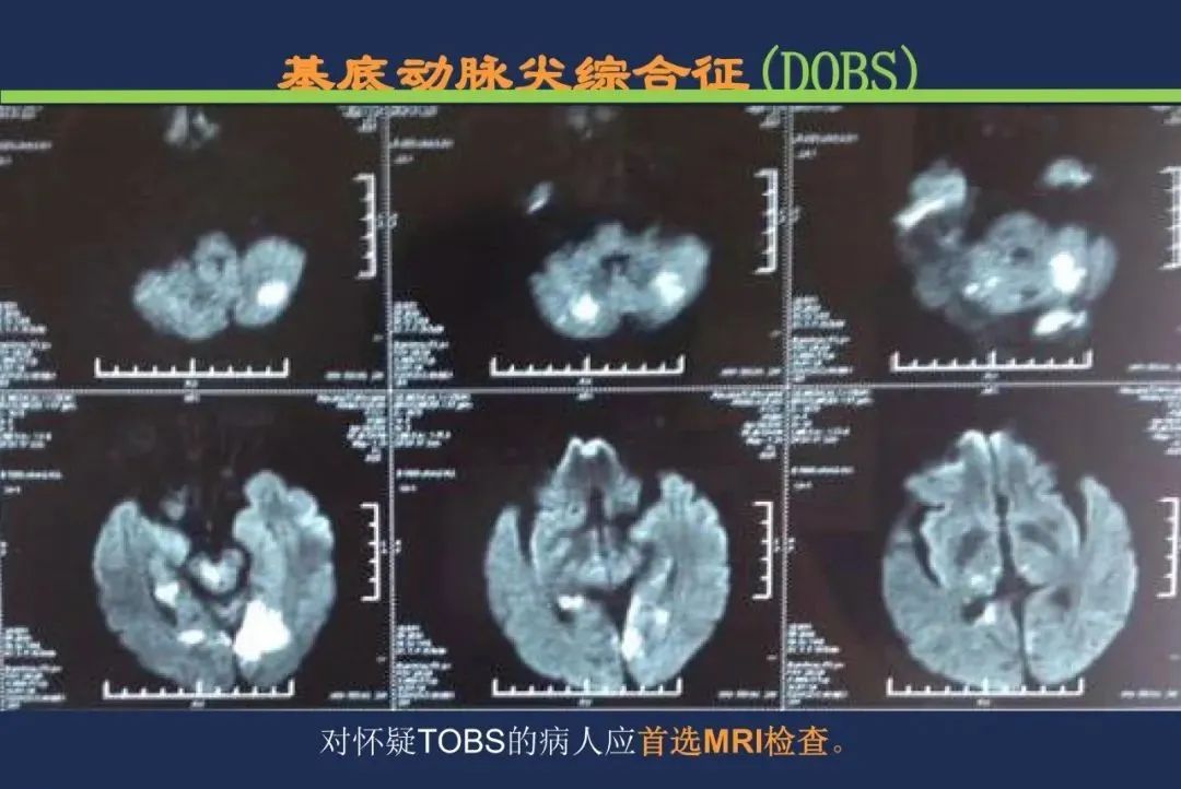 影像PPT - 从梗死部位推测责任血管:脑血管解剖-205 影像PPT - 从梗死部位推测责任血管:脑血管解剖-205
