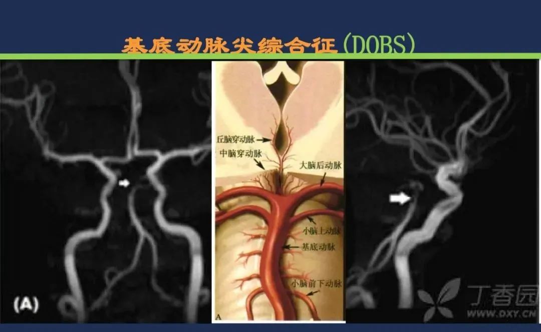 影像PPT - 从梗死部位推测责任血管:脑血管解剖-206 影像PPT - 从梗死部位推测责任血管:脑血管解剖-206