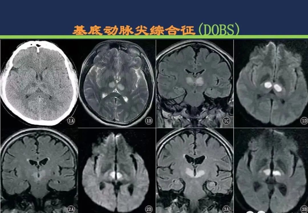 影像PPT - 从梗死部位推测责任血管:脑血管解剖-207 影像PPT - 从梗死部位推测责任血管:脑血管解剖-207