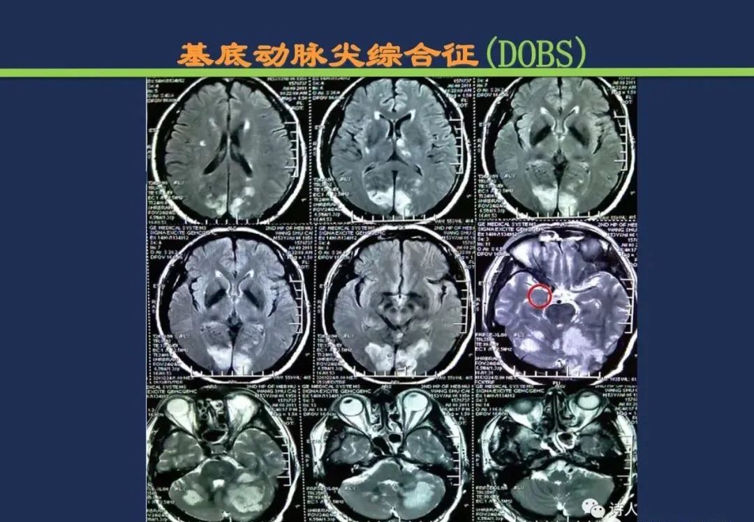 影像PPT - 从梗死部位推测责任血管:脑血管解剖-208 影像PPT - 从梗死部位推测责任血管:脑血管解剖-208