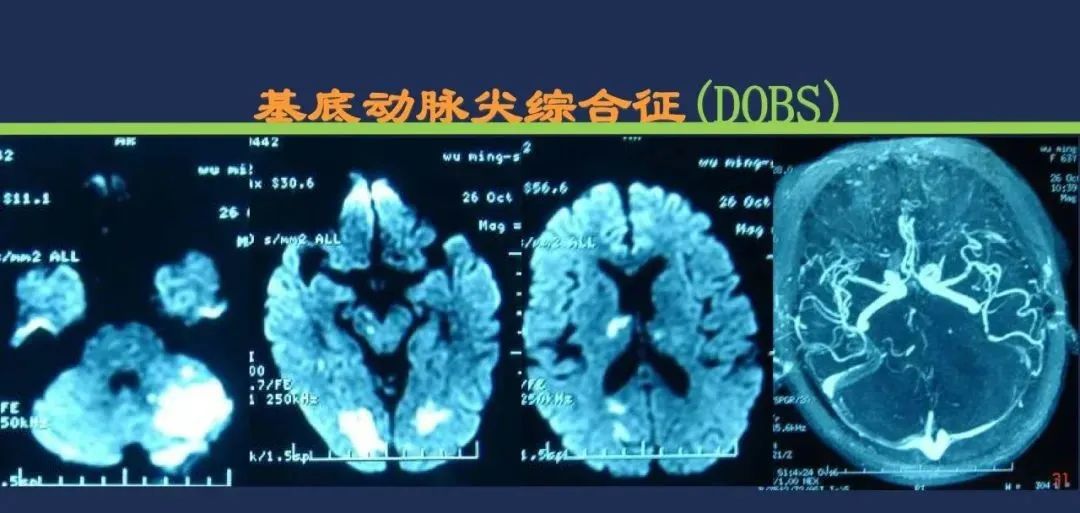 影像PPT - 从梗死部位推测责任血管:脑血管解剖-209 影像PPT - 从梗死部位推测责任血管:脑血管解剖-209