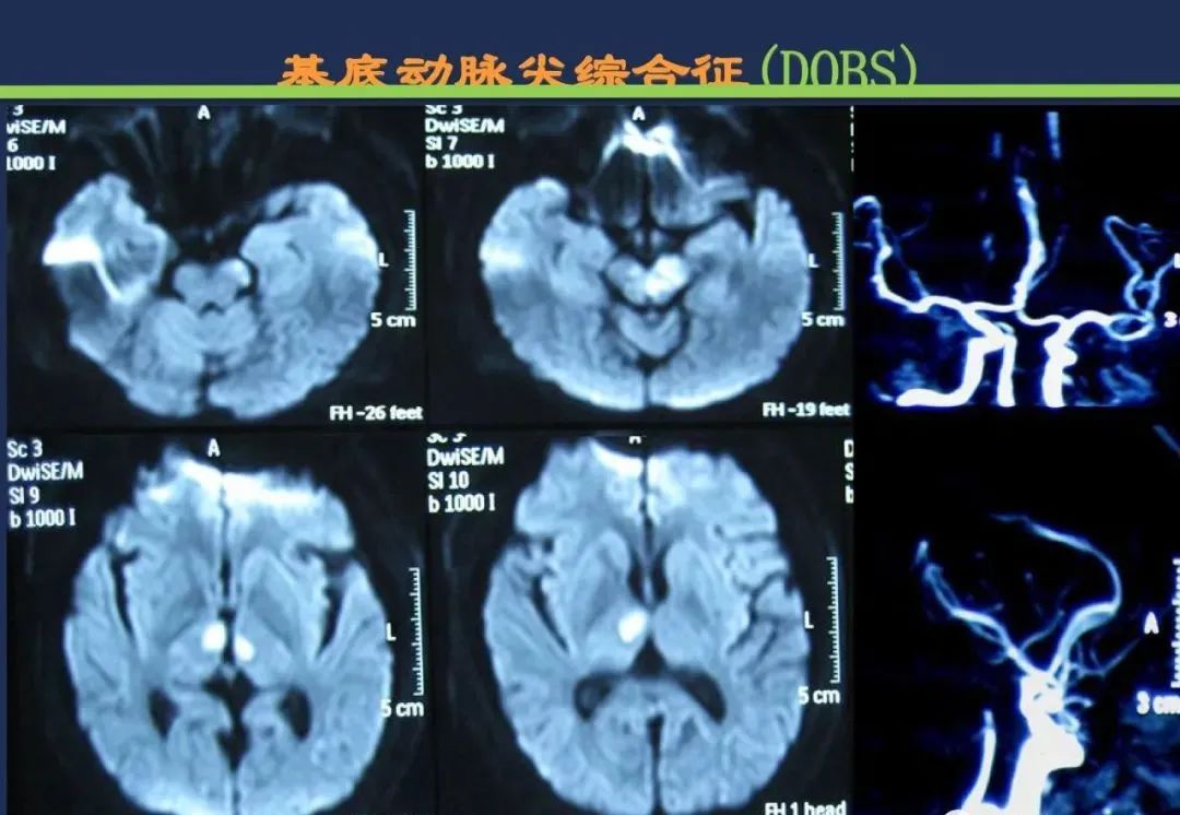 影像PPT - 从梗死部位推测责任血管:脑血管解剖-210 影像PPT - 从梗死部位推测责任血管:脑血管解剖-210
