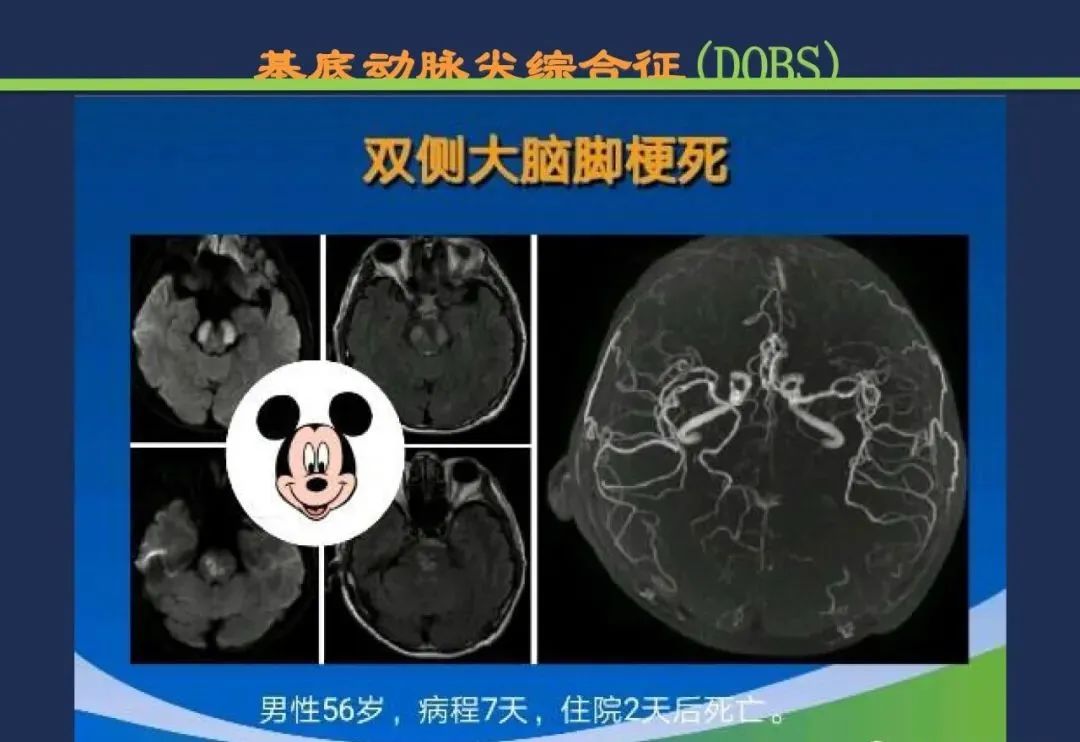 影像PPT - 从梗死部位推测责任血管:脑血管解剖-211 影像PPT - 从梗死部位推测责任血管:脑血管解剖-211