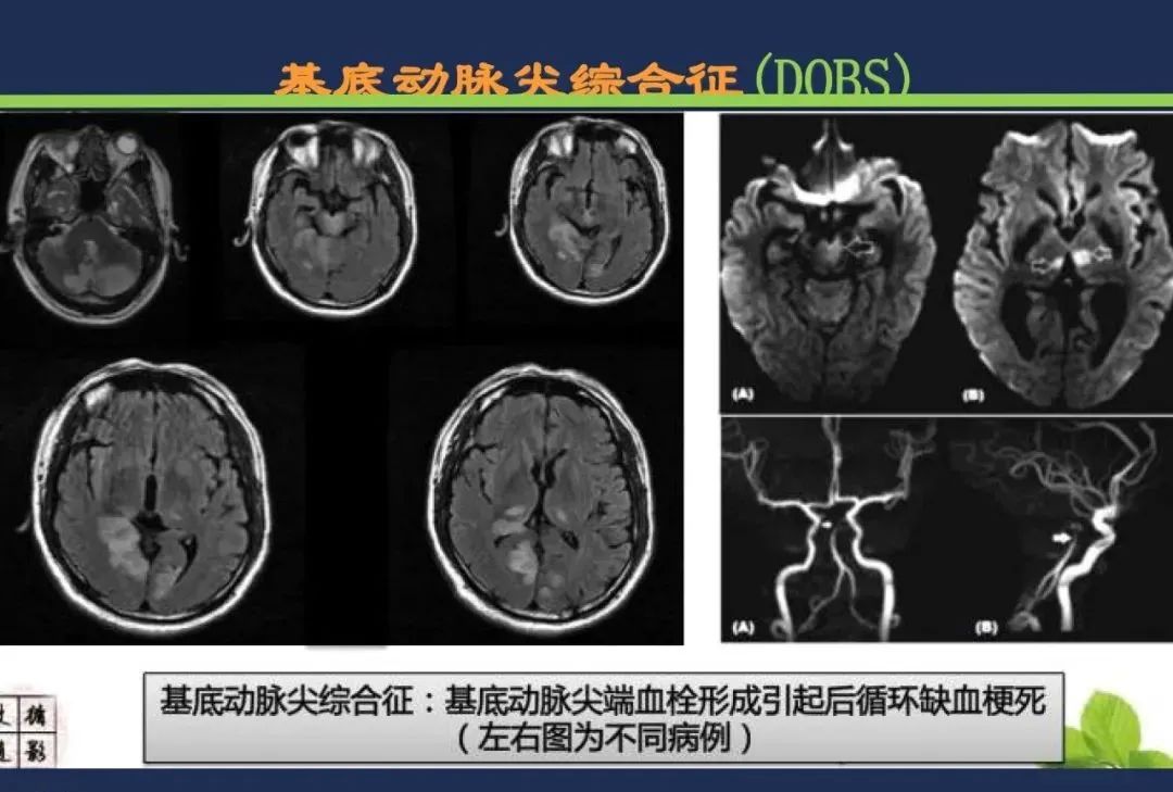 影像PPT - 从梗死部位推测责任血管:脑血管解剖-212 影像PPT - 从梗死部位推测责任血管:脑血管解剖-212