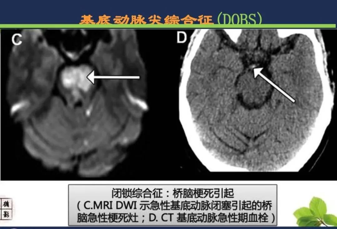 影像PPT - 从梗死部位推测责任血管:脑血管解剖-213 影像PPT - 从梗死部位推测责任血管:脑血管解剖-213