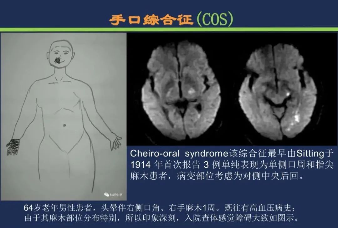 影像PPT - 从梗死部位推测责任血管:脑血管解剖-214 影像PPT - 从梗死部位推测责任血管:脑血管解剖-214
