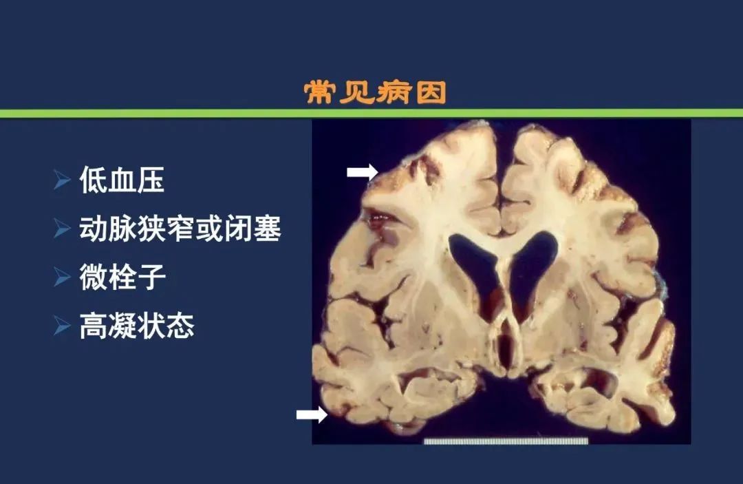 影像PPT - 从梗死部位推测责任血管:脑血管解剖-219 影像PPT - 从梗死部位推测责任血管:脑血管解剖-219