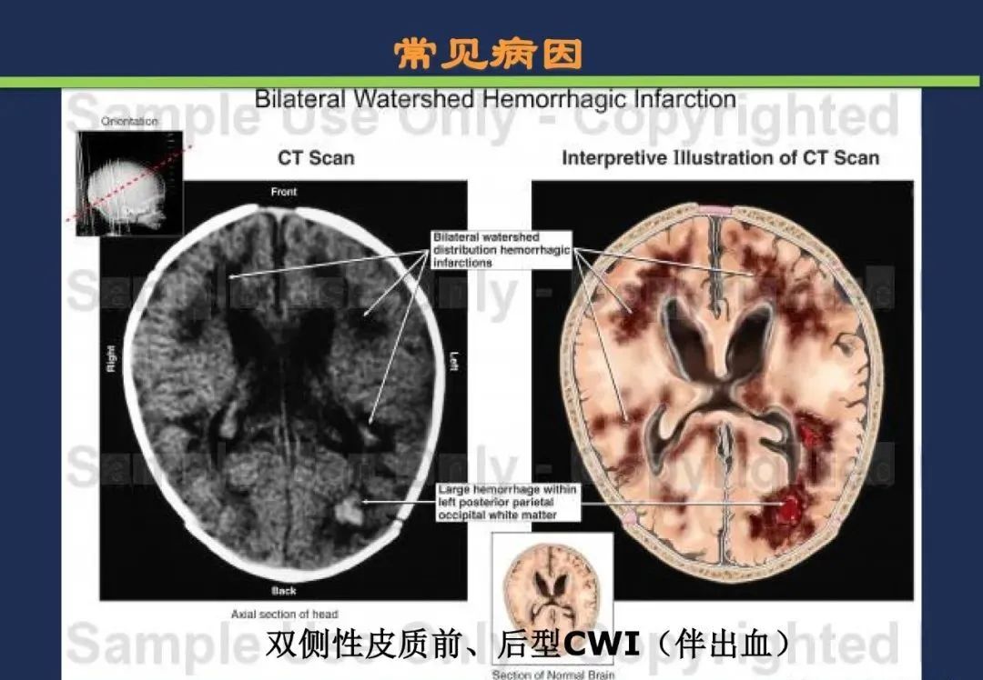 影像PPT - 从梗死部位推测责任血管:脑血管解剖-221 影像PPT - 从梗死部位推测责任血管:脑血管解剖-221