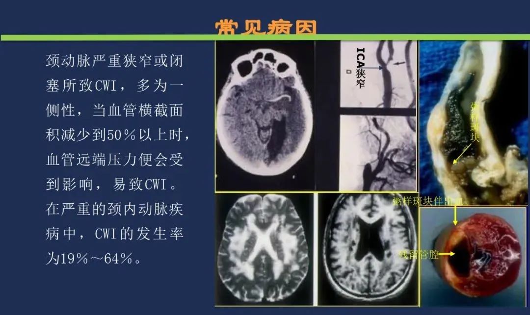 影像PPT - 从梗死部位推测责任血管:脑血管解剖-222 影像PPT - 从梗死部位推测责任血管:脑血管解剖-222