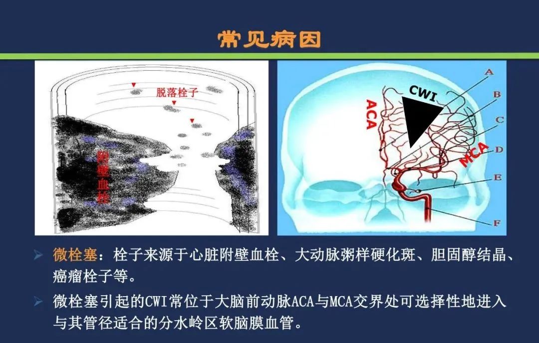 影像PPT - 从梗死部位推测责任血管:脑血管解剖-223 影像PPT - 从梗死部位推测责任血管:脑血管解剖-223