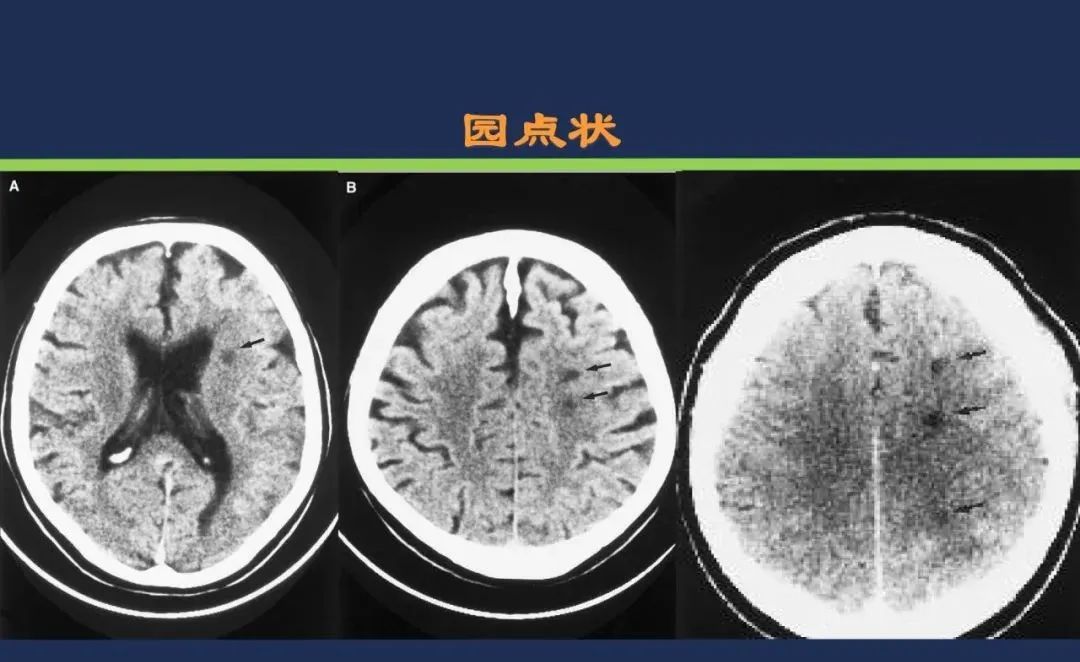 影像PPT - 从梗死部位推测责任血管:脑血管解剖-225 影像PPT - 从梗死部位推测责任血管:脑血管解剖-225