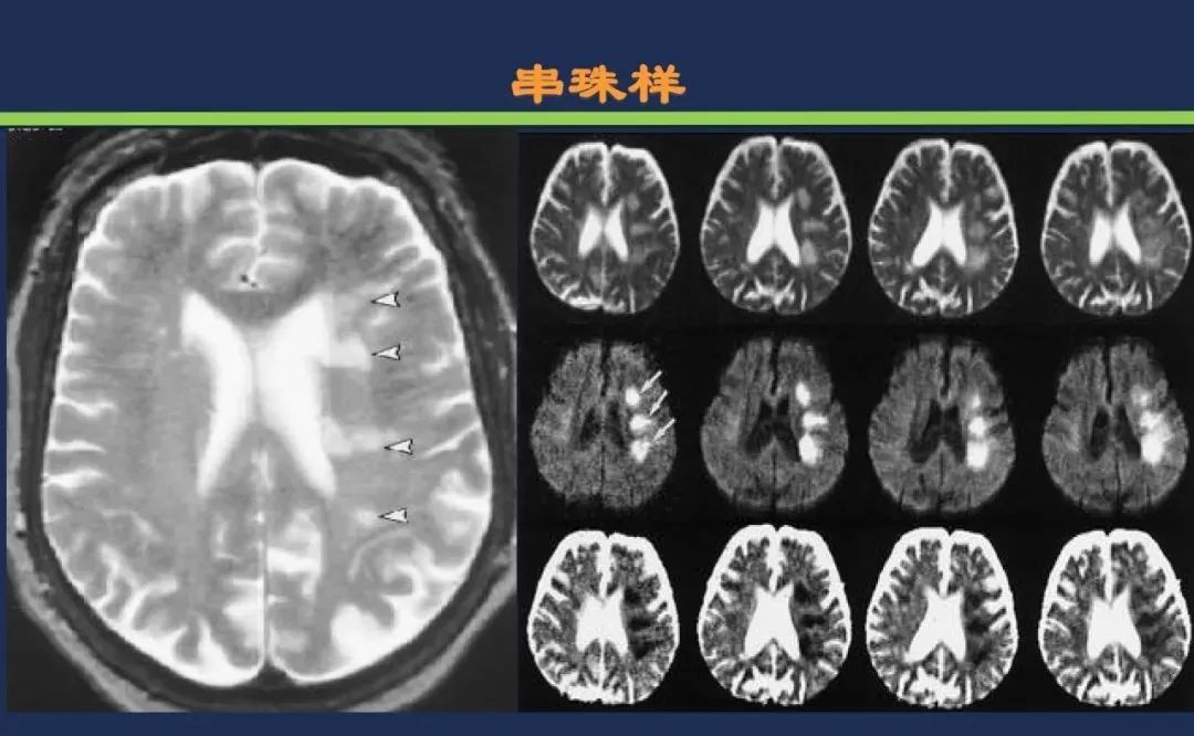 影像PPT - 从梗死部位推测责任血管:脑血管解剖-226 影像PPT - 从梗死部位推测责任血管:脑血管解剖-226