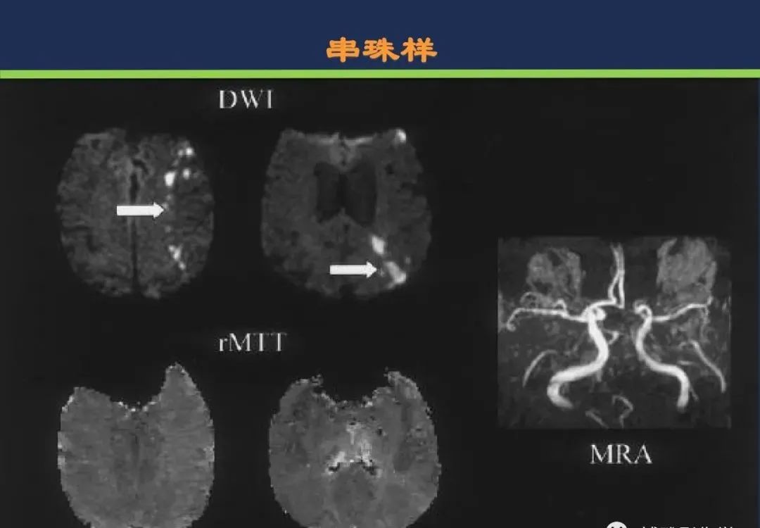 影像PPT - 从梗死部位推测责任血管:脑血管解剖-227 影像PPT - 从梗死部位推测责任血管:脑血管解剖-227