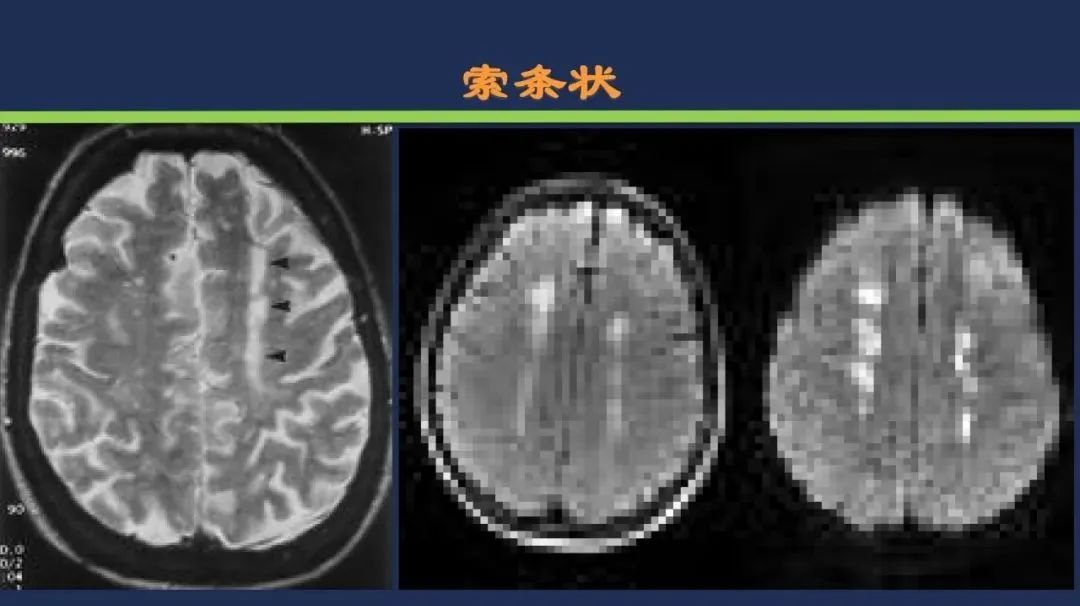 影像PPT - 从梗死部位推测责任血管:脑血管解剖-228 影像PPT - 从梗死部位推测责任血管:脑血管解剖-228