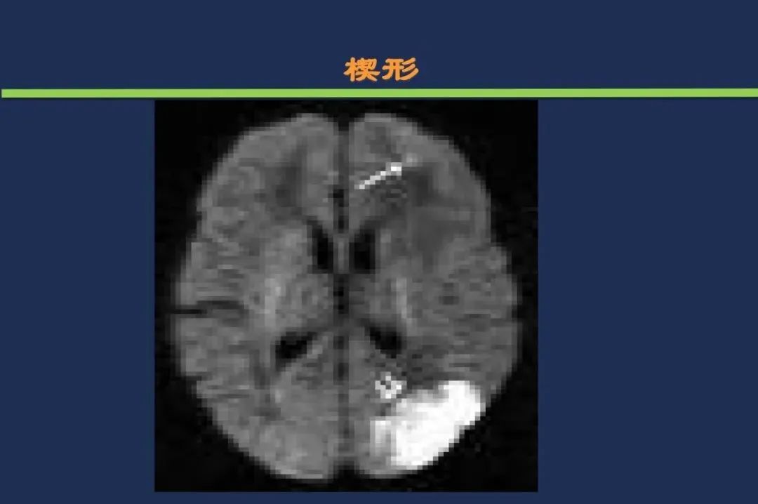 影像PPT - 从梗死部位推测责任血管:脑血管解剖-229 影像PPT - 从梗死部位推测责任血管:脑血管解剖-229