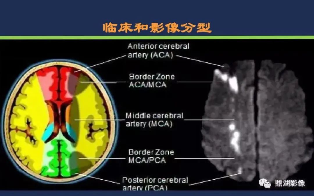 影像PPT - 从梗死部位推测责任血管:脑血管解剖-231 影像PPT - 从梗死部位推测责任血管:脑血管解剖-231