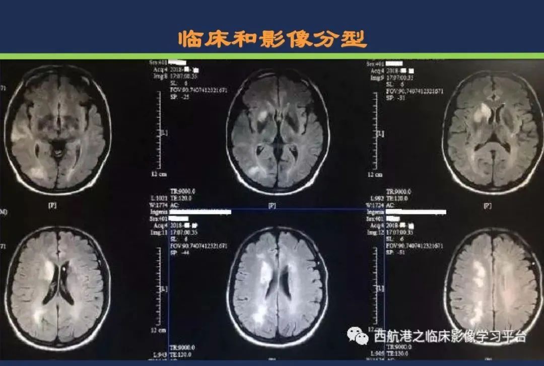 影像PPT - 从梗死部位推测责任血管:脑血管解剖-235 影像PPT - 从梗死部位推测责任血管:脑血管解剖-235