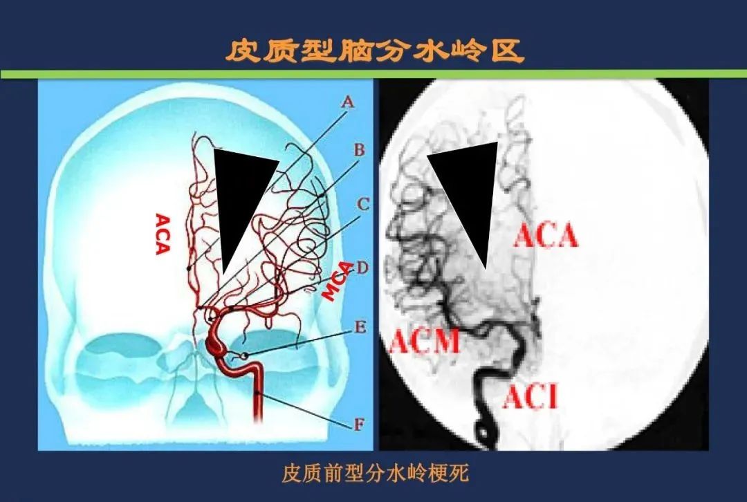 影像PPT - 从梗死部位推测责任血管:脑血管解剖-238 影像PPT - 从梗死部位推测责任血管:脑血管解剖-238