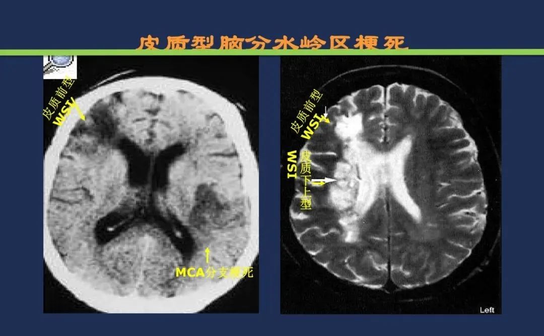 影像PPT - 从梗死部位推测责任血管:脑血管解剖-241 影像PPT - 从梗死部位推测责任血管:脑血管解剖-241