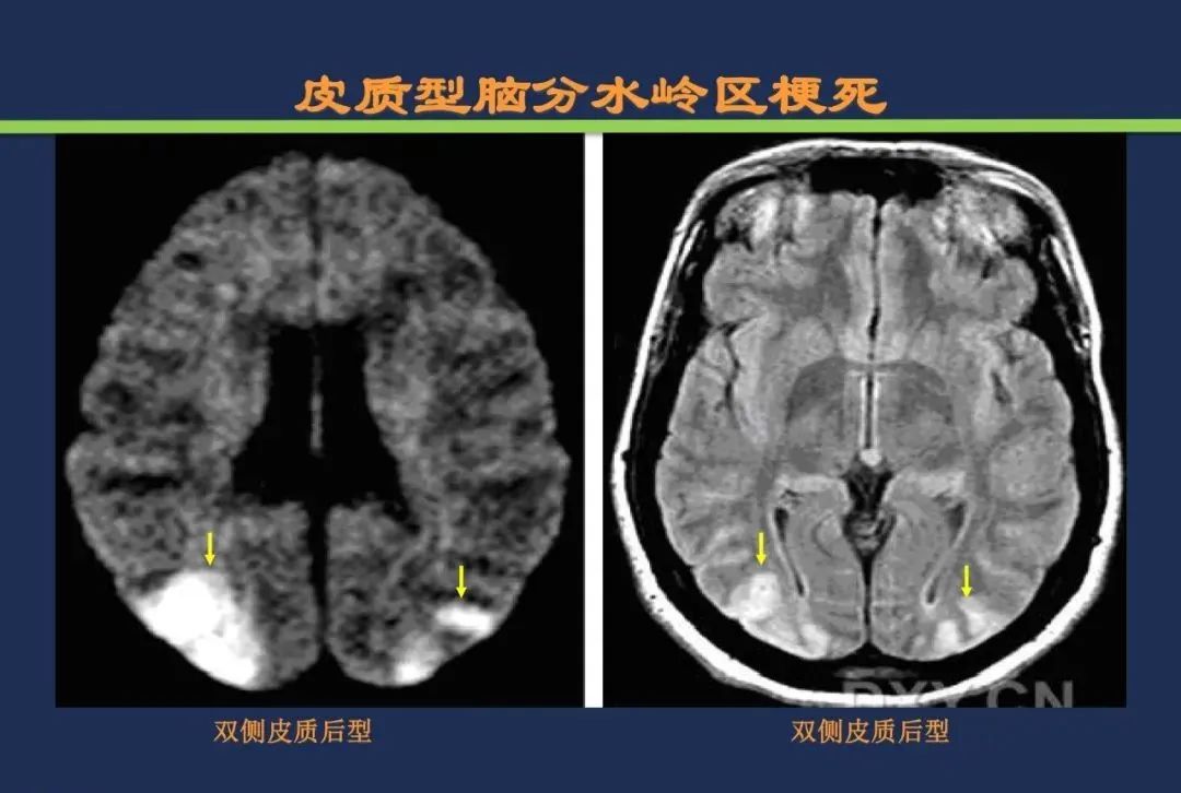 影像PPT - 从梗死部位推测责任血管:脑血管解剖-242 影像PPT - 从梗死部位推测责任血管:脑血管解剖-242