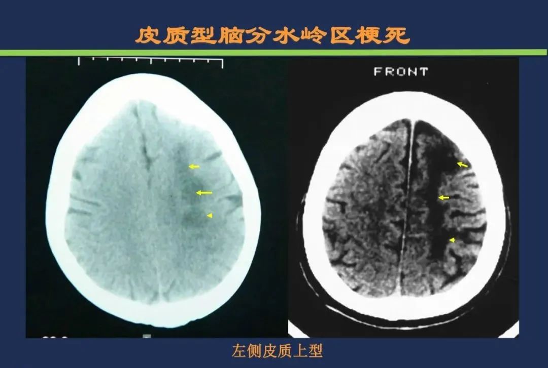 影像PPT - 从梗死部位推测责任血管:脑血管解剖-243 影像PPT - 从梗死部位推测责任血管:脑血管解剖-243