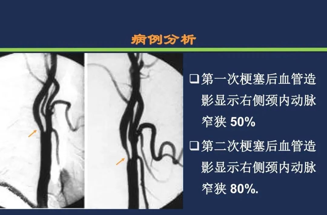 影像PPT - 从梗死部位推测责任血管:脑血管解剖-244 影像PPT - 从梗死部位推测责任血管:脑血管解剖-244