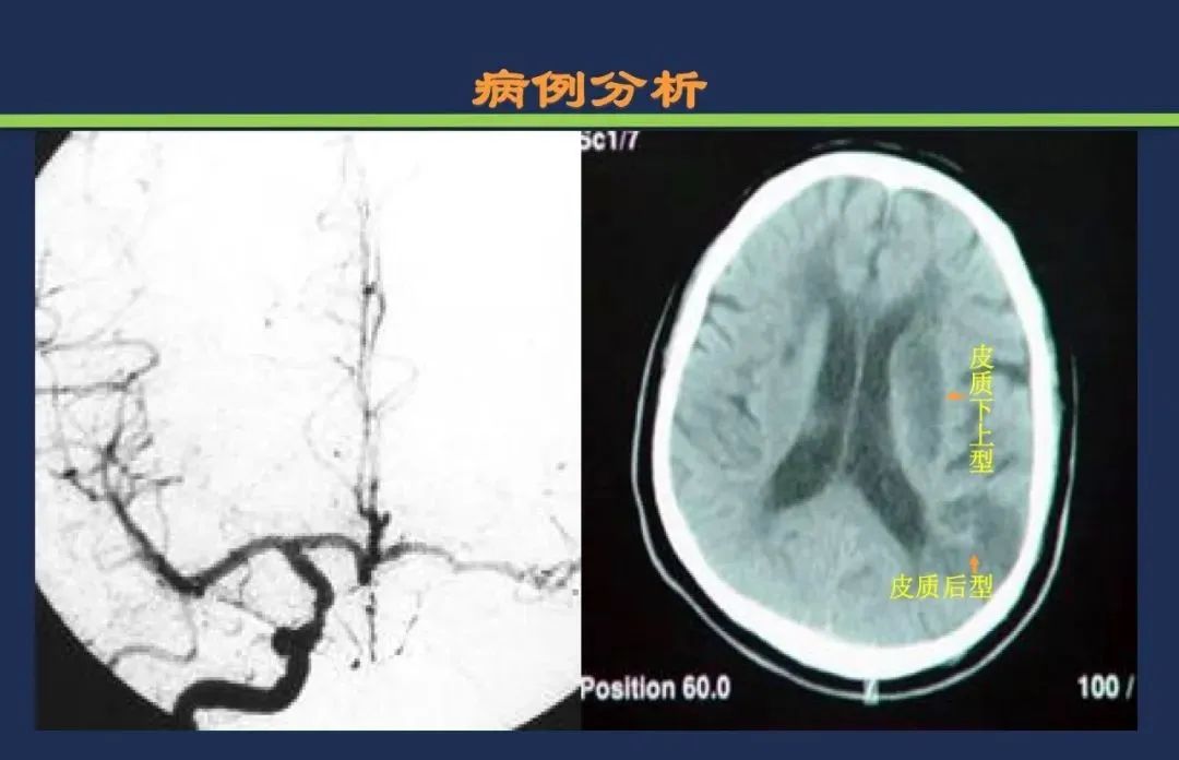 影像PPT - 从梗死部位推测责任血管:脑血管解剖-245 影像PPT - 从梗死部位推测责任血管:脑血管解剖-245