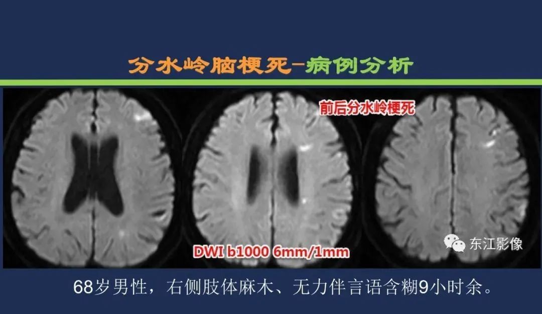 影像PPT - 从梗死部位推测责任血管:脑血管解剖-246 影像PPT - 从梗死部位推测责任血管:脑血管解剖-246