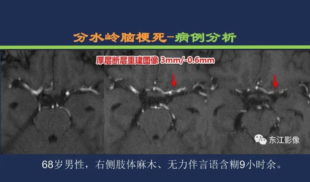 影像PPT - 从梗死部位推测责任血管:脑血管解剖-247 影像PPT - 从梗死部位推测责任血管:脑血管解剖-247