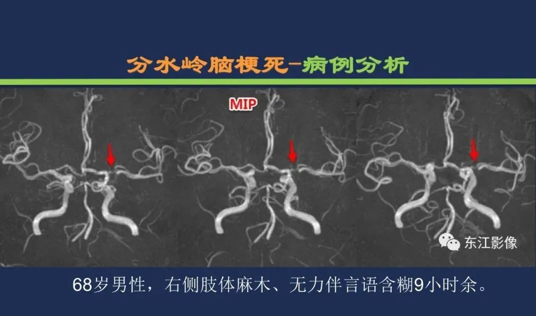 影像PPT - 从梗死部位推测责任血管:脑血管解剖-248 影像PPT - 从梗死部位推测责任血管:脑血管解剖-248
