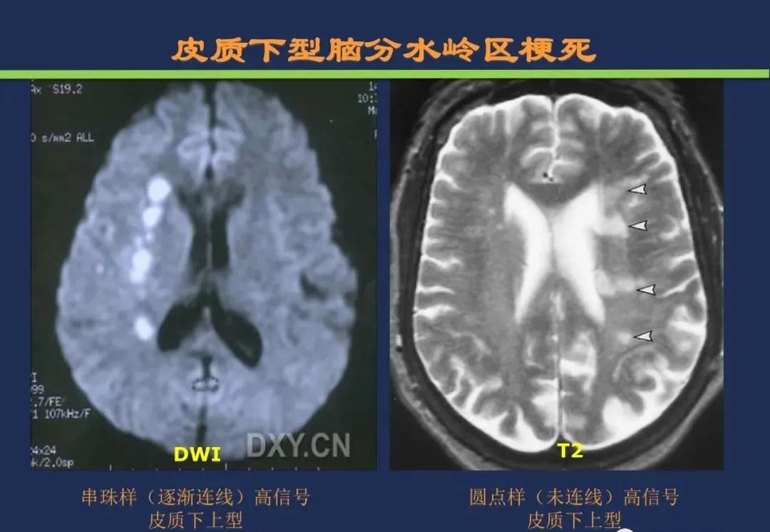 影像PPT - 从梗死部位推测责任血管:脑血管解剖-249 影像PPT - 从梗死部位推测责任血管:脑血管解剖-249