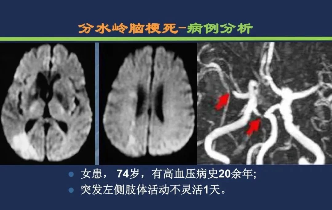 影像PPT - 从梗死部位推测责任血管:脑血管解剖-250 影像PPT - 从梗死部位推测责任血管:脑血管解剖-250