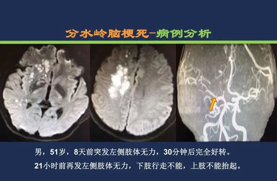 影像PPT - 从梗死部位推测责任血管:脑血管解剖-251 影像PPT - 从梗死部位推测责任血管:脑血管解剖-251