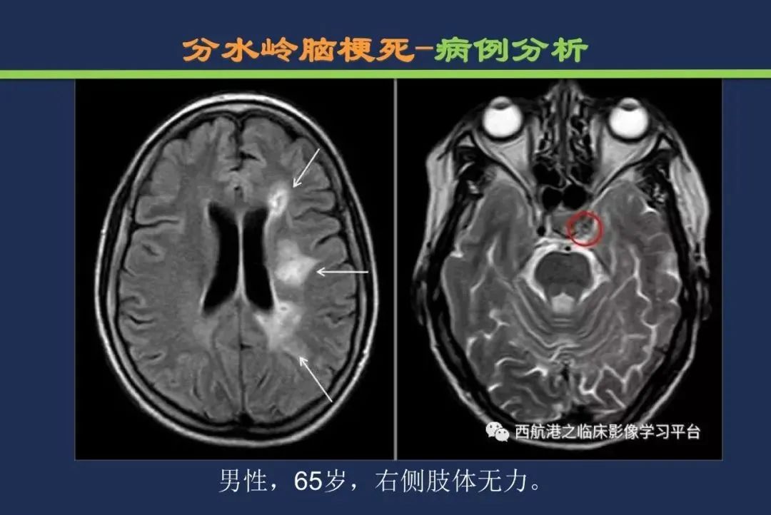 影像PPT - 从梗死部位推测责任血管:脑血管解剖-252 影像PPT - 从梗死部位推测责任血管:脑血管解剖-252