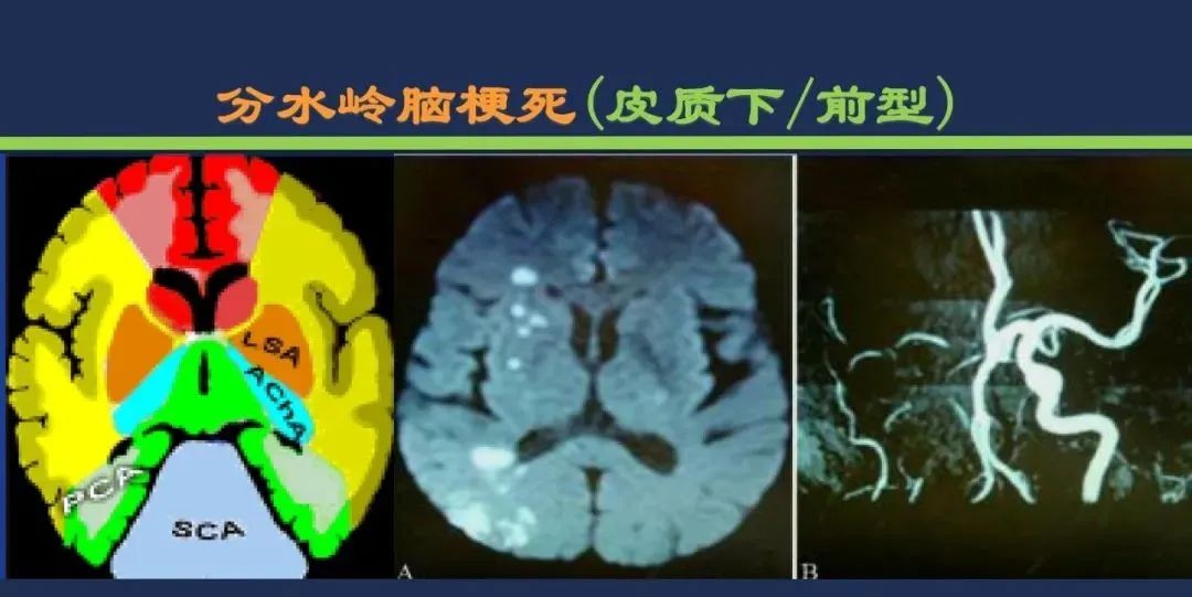 影像PPT - 从梗死部位推测责任血管:脑血管解剖-253 影像PPT - 从梗死部位推测责任血管:脑血管解剖-253
