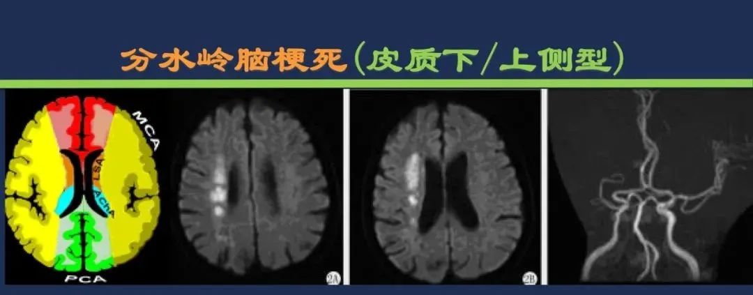 影像PPT - 从梗死部位推测责任血管:脑血管解剖-254 影像PPT - 从梗死部位推测责任血管:脑血管解剖-254