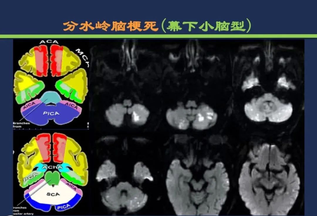 影像PPT - 从梗死部位推测责任血管:脑血管解剖-255 影像PPT - 从梗死部位推测责任血管:脑血管解剖-255