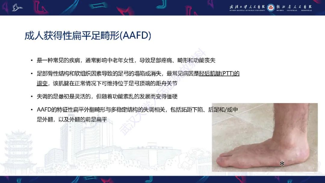 影像PPT - 【PPT】成人获得性扁平足畸形: 解剖学、生物力学、分期和影像学表现-2