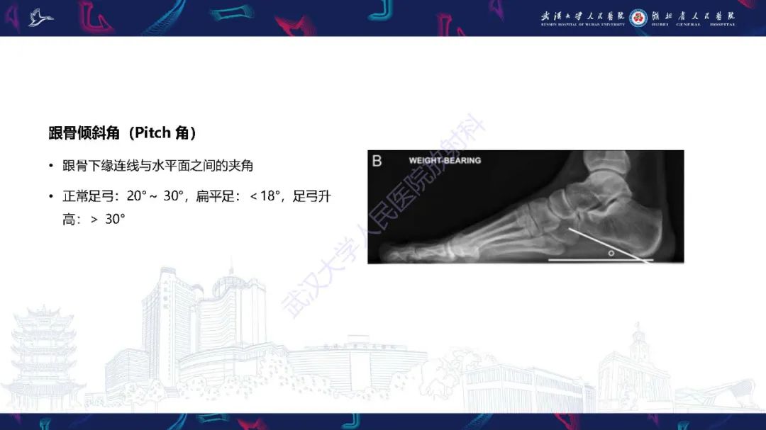 影像PPT - 【PPT】成人获得性扁平足畸形: 解剖学、生物力学、分期和影像学表现-10
