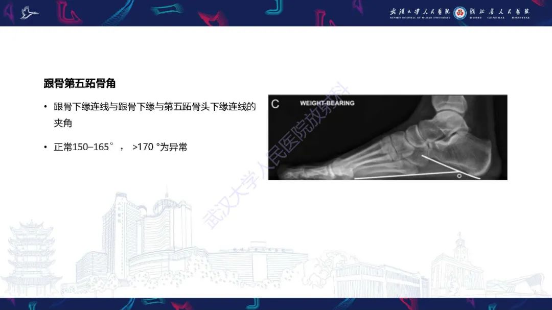 影像PPT - 【PPT】成人获得性扁平足畸形: 解剖学、生物力学、分期和影像学表现-11