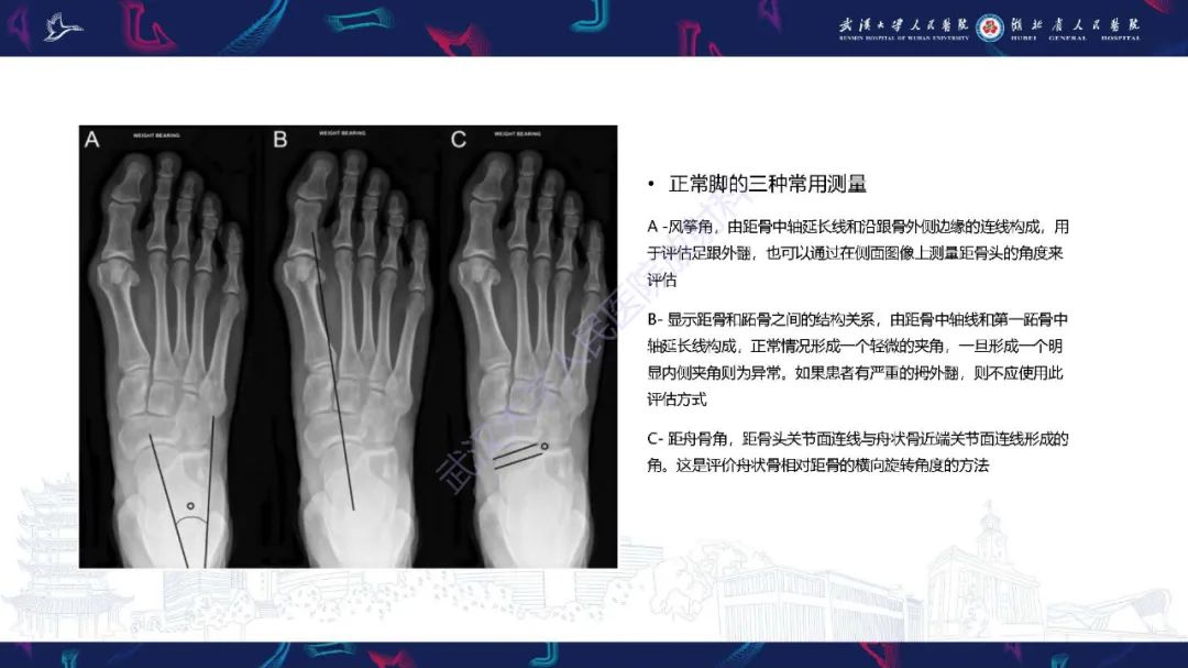 影像PPT - 【PPT】成人获得性扁平足畸形: 解剖学、生物力学、分期和影像学表现-12